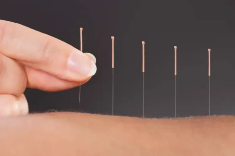 Akupunktur Medik Dan Akupunktur Tradisional/TCM